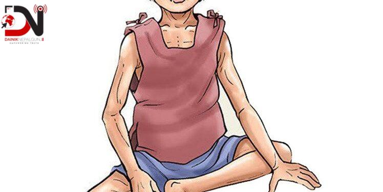 कुपोषणः बाँके लुम्बिनीकै उच्च जोखिममा, २ को मृत्यु, ४२५ बिरामी