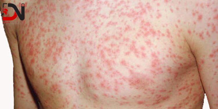 दादुरा–रुवेलाविरुद्धको खोप अभियान २५ दिनसम्म सञ्चालन हुने