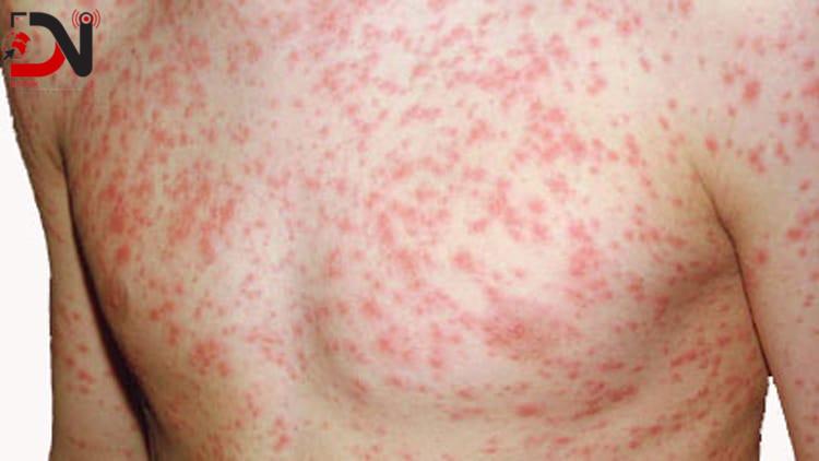 दादुरा–रुवेलाविरुद्धको खोप अभियान २५ दिनसम्म सञ्चालन हुने