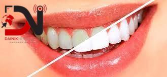 ‘नियमित जाँच गरे मुखसम्बन्धी रोगले जटिलता निम्त्याउँदैन’