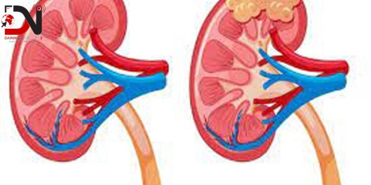 विश्व मिर्गौला दिवस : डायलायसिसभन्दा प्रत्यारोपण उपयुक्त