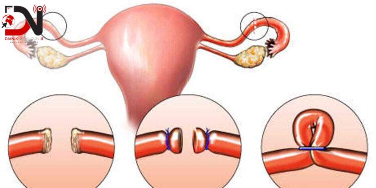 स्थायी बन्ध्याकरण गर्नेमा पुरुषभन्दा महिला बढी
