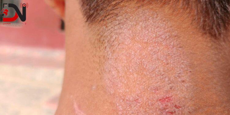 सुधार गृहका बालकमा छाला सम्बन्धी रोग