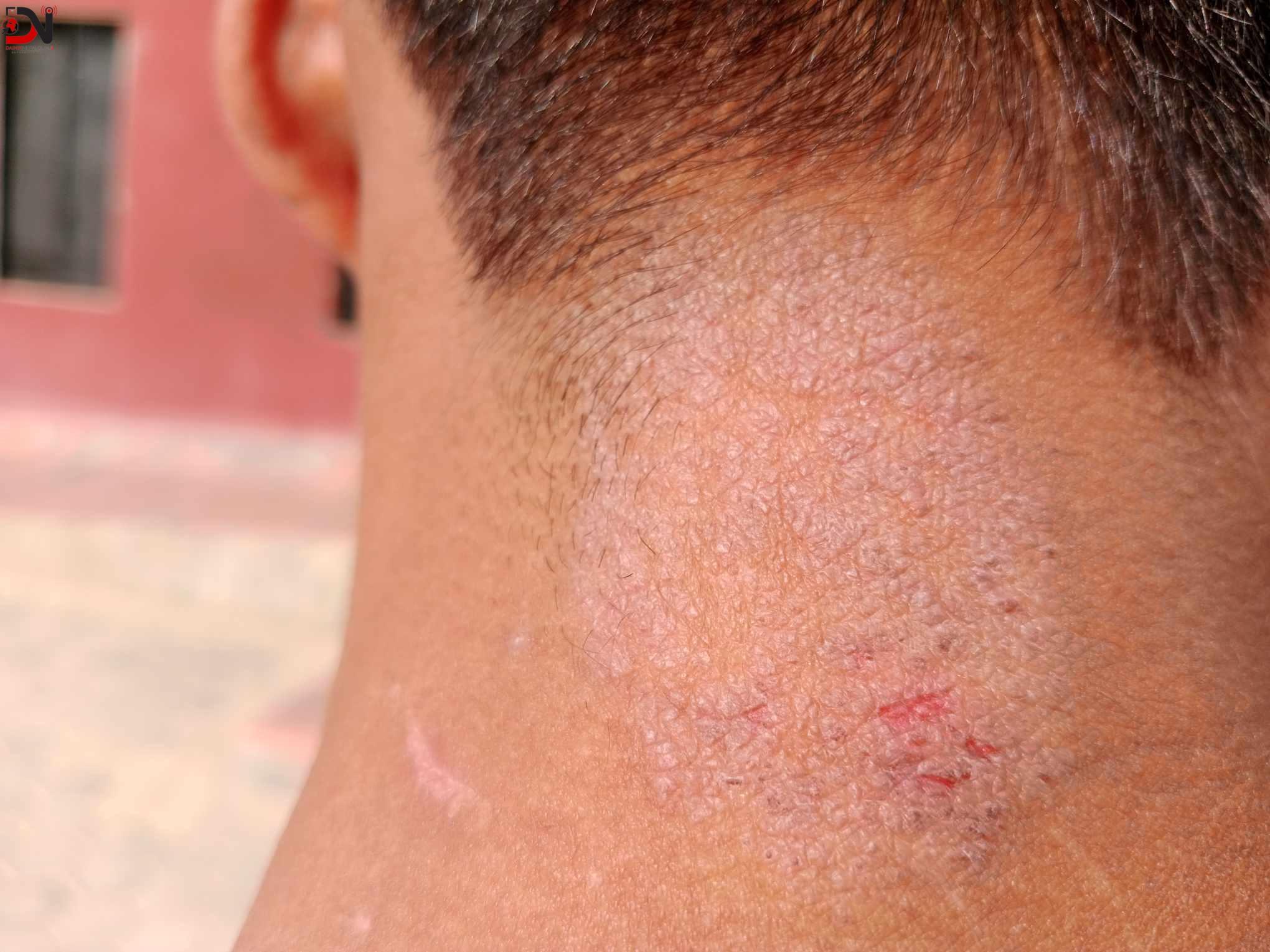 सुधार गृहका बालकमा छाला सम्बन्धी रोग