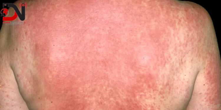 अत्याधिक गर्मीले बाँकेमा छालाका बिरामी बढे