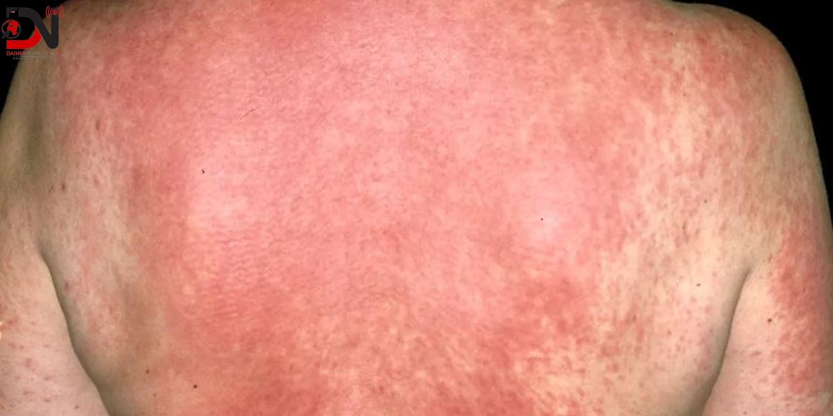 अत्याधिक गर्मीले बाँकेमा छालाका बिरामी बढे