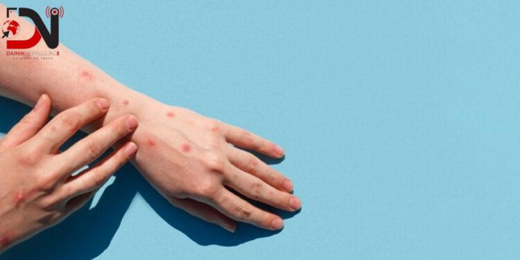 मङ्कीपक्स सङ्क्रमणको जोखिममा नेपाल