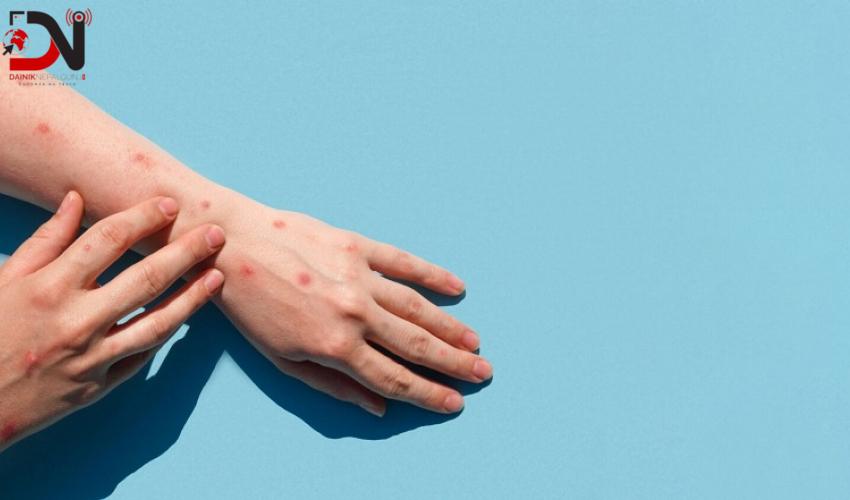 मङ्कीपक्स सङ्क्रमणको जोखिममा नेपाल