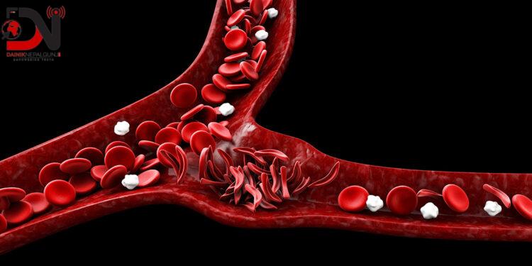 सिकलसेल प्रति संवेदनशील बन्दै सरकार