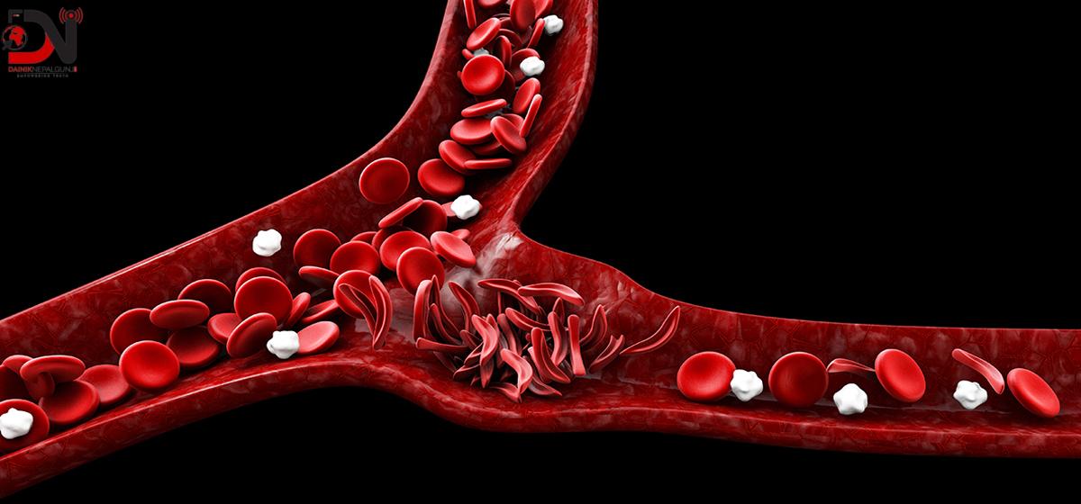 सिकलसेल प्रति संवेदनशील बन्दै सरकार