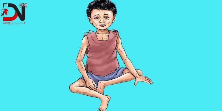 बाँकेका सबै स्थानीय तहमा कुपोषणका बालबालिका