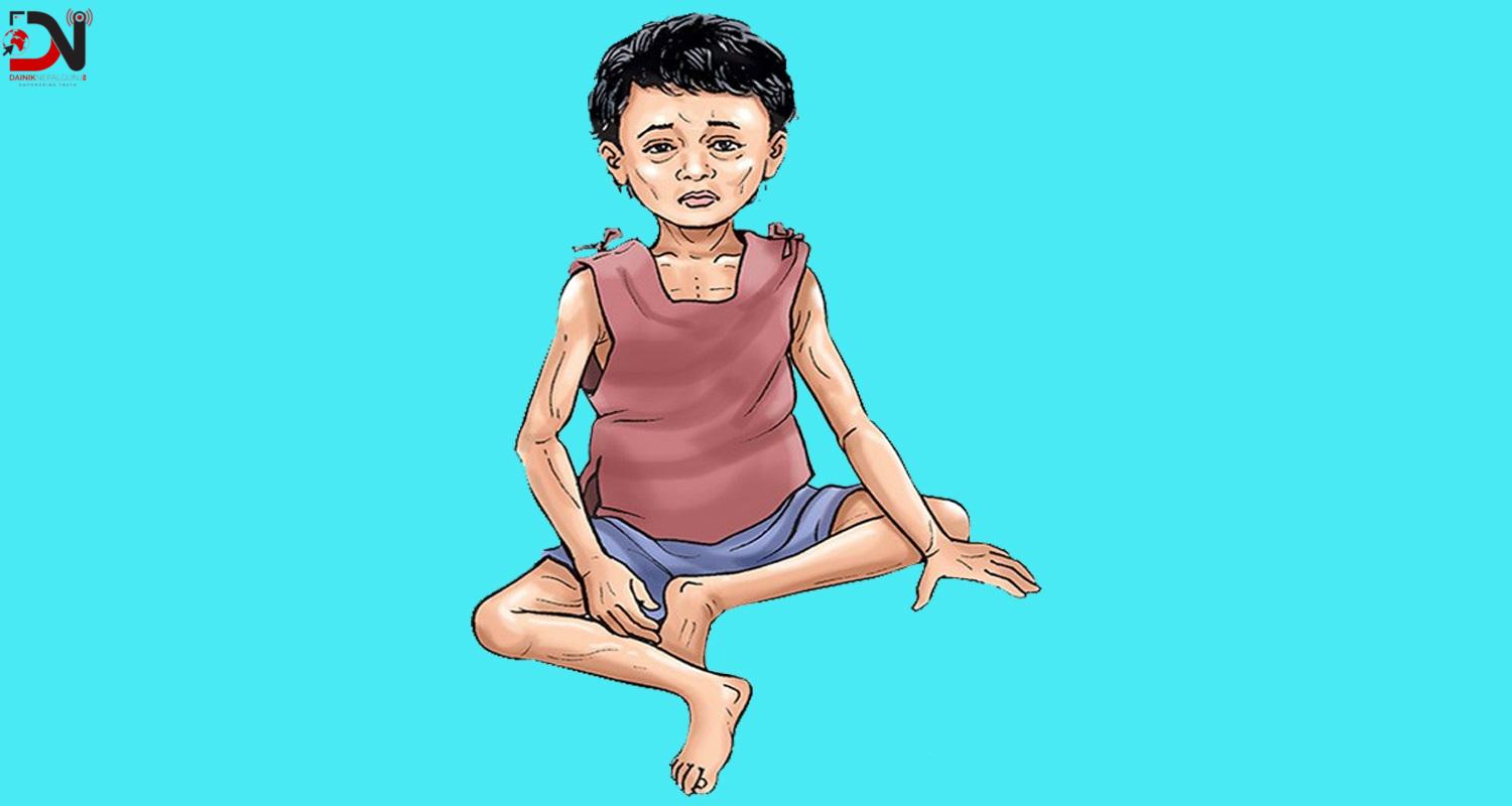 बाँकेका सबै स्थानीय तहमा कुपोषणका बालबालिका