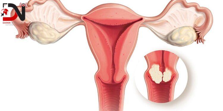 पाठेघरको मुखको क्यान्सर रोकथामका फागुन महिनाभर परीक्षण
