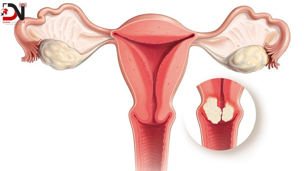 पाठेघरको मुखको क्यान्सर रोकथामका फागुन महिनाभर परीक्षण
