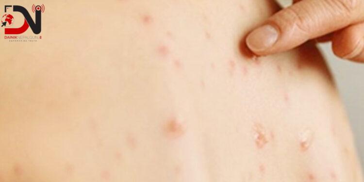 नेपाल रुबेला–मुक्त देश घोषित, नेपालीका लागि गर्वको विषय हो : स्वास्थ्यमन्त्री पौडेल