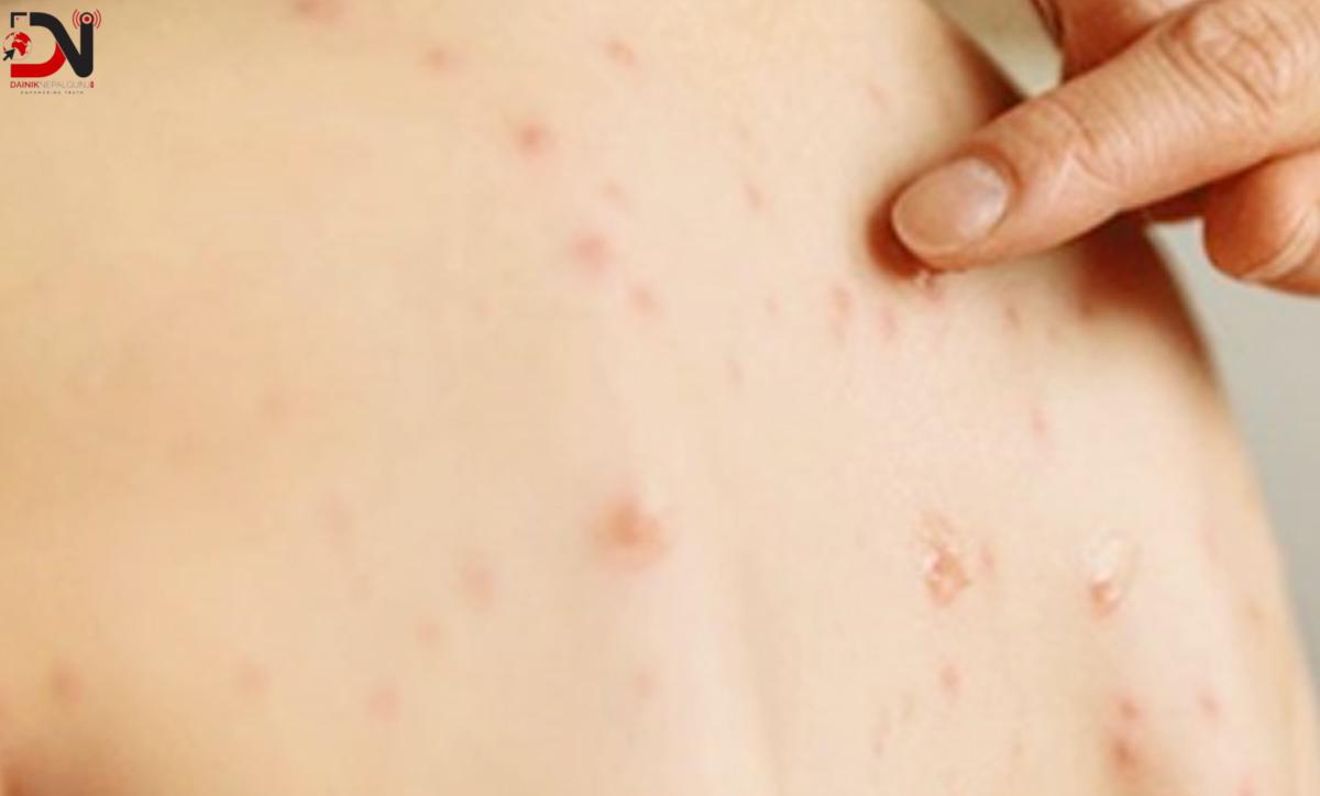 नेपाल रुबेला–मुक्त देश घोषित, नेपालीका लागि गर्वको विषय हो : स्वास्थ्यमन्त्री पौडेल